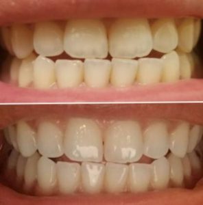 جهاز كرست لتبييض الاسنان Crest™ 3DWhitestrips Teeth Whitening Kit photo review